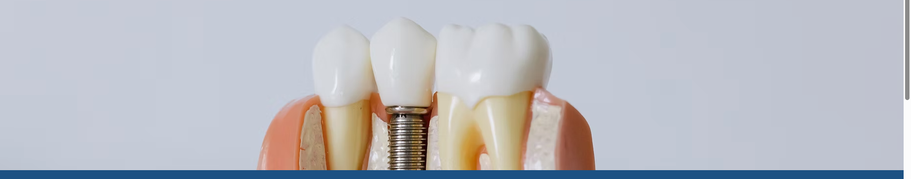 Implant dentaire